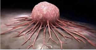 cancer